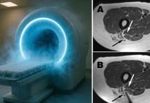 அறுவை சிகிச்சை இல்லாமல் புற்றுநோய் குணமக்கும் முறை கண்டுபிடிப்பு
